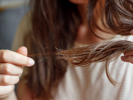 Sudden severe hair loss in women