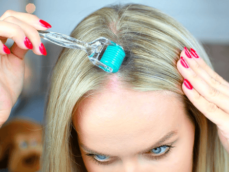 Microneedling therapy with Dermaroller: proven effective against hair loss